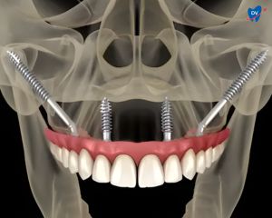Zygomatic implants