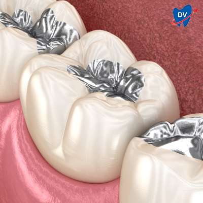 Amalgam Filling Amalgam Filling