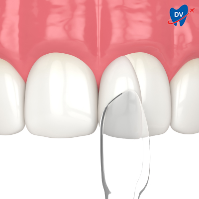 Composite Bonding Composite Bonding