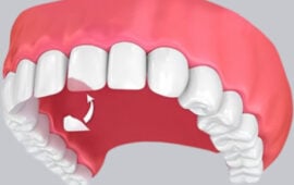 composite bonding