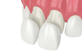 Dental Veneers