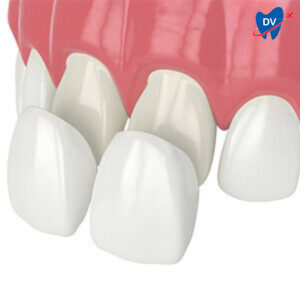 Dental Veneers