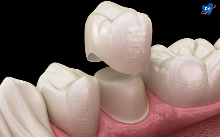 Dental Crowns in Chandigarh