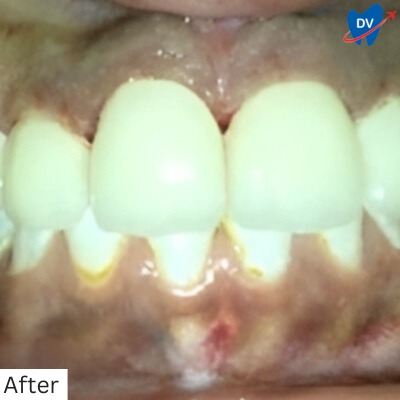 Dental Crowns Panchkula - After