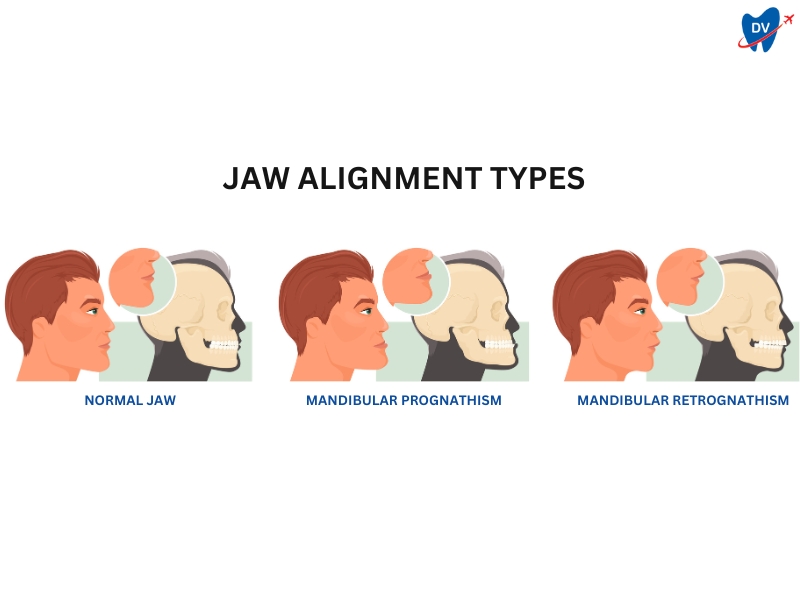 Jaw Alignment Types Jaw Alignment Types