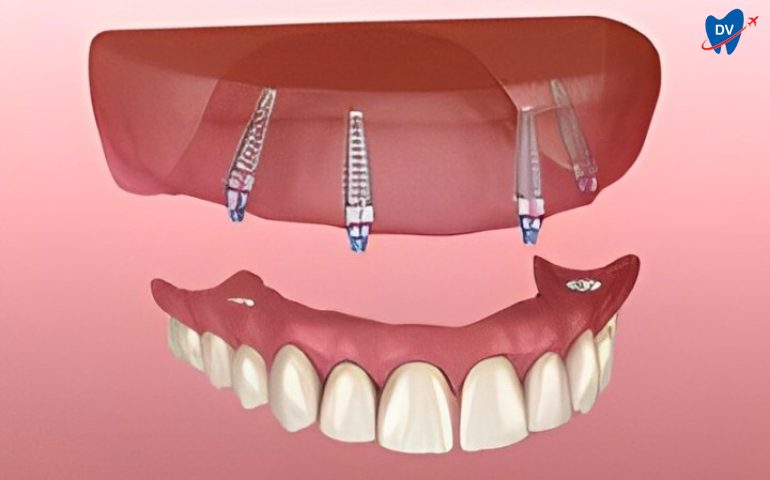 All On 4 Implant