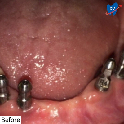 Implant supported bridge - Before