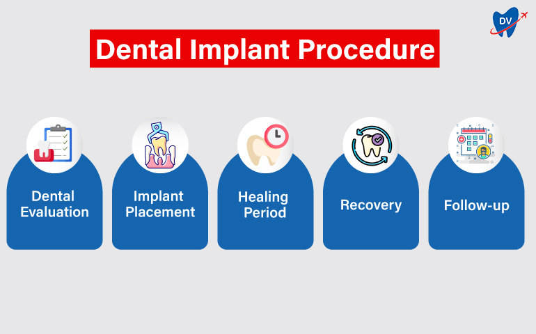 Dental-Implant-Procedure-steps