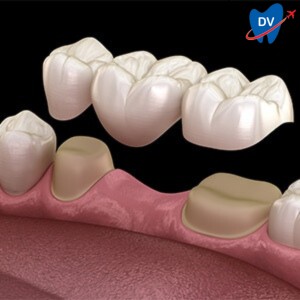 Traditional Dental Bridge