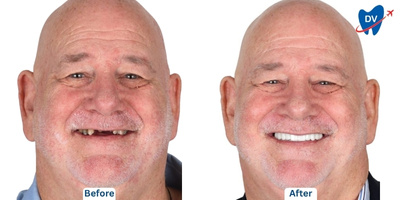before and after all on 4 in Thailand