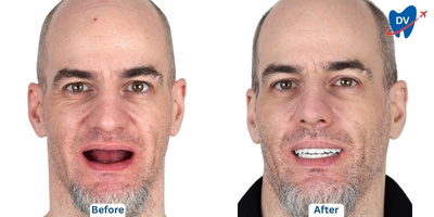Before & after all on 4 in Thailand