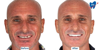 Before & after all on 4 in Thailand