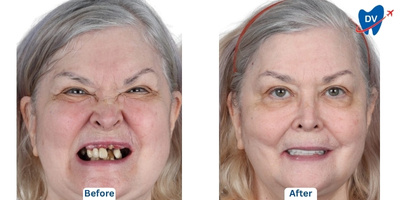 Before and After all on 4 in Thailand