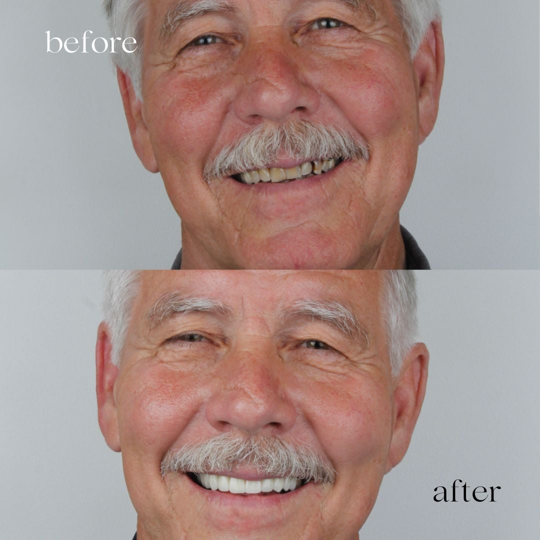 Before and after getting full set veneers at Aesthetic Dental Care, Costa Rica
