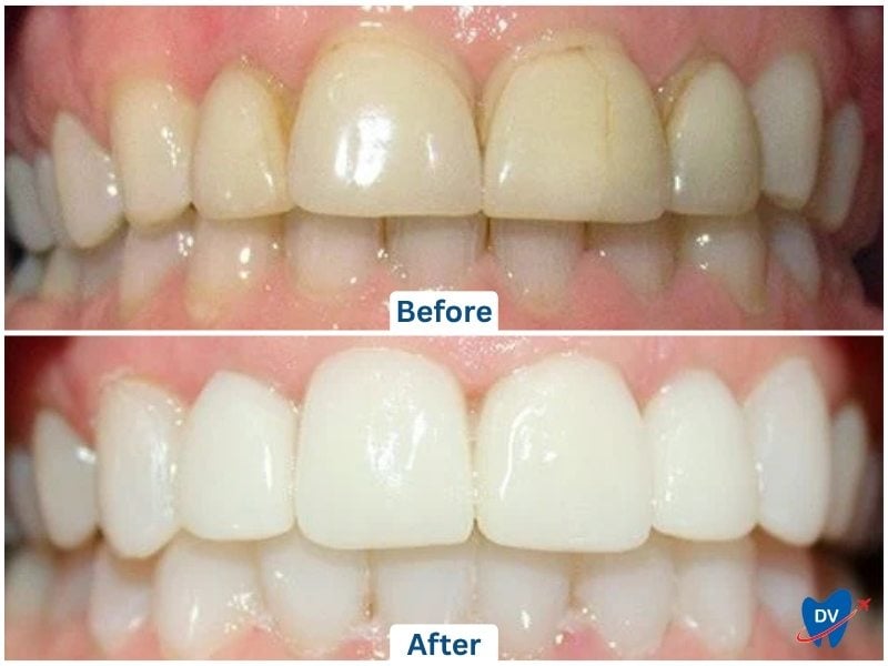 Before and After Images of Dental Veneers In Cancun