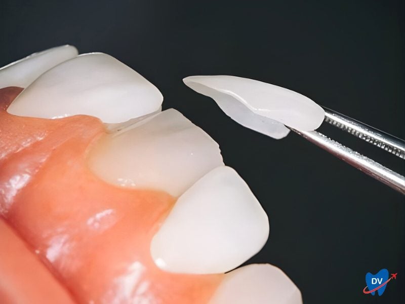 Dental Veneer