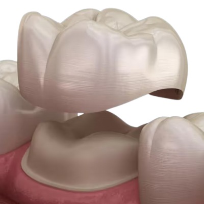 Dental Bonding