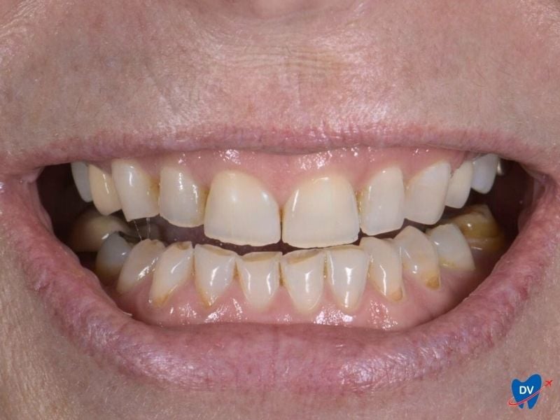 Discolored and misshapen teeth
