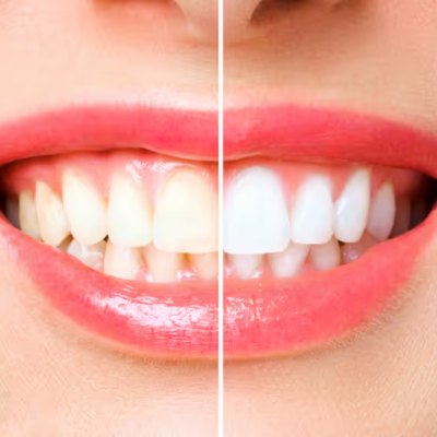 Before and after teeth whitening