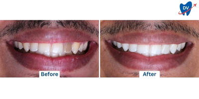 Dental Veneers in Dominican Republic: Before and After