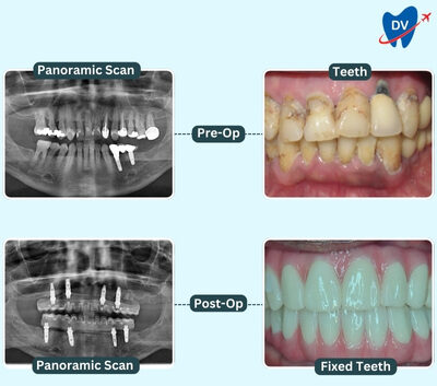 All-on-4 procedure at Dental Brush Clinic, Tijuana, Mexico
