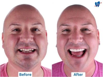 Before and after of porcelain veneers in Los Algodones