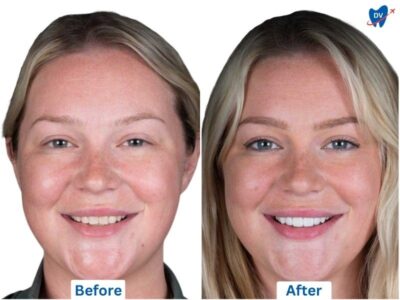 Before and After of porcelain veneers in Los Algodones