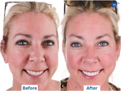 Before and after of zirconia veneers in Los Algodones