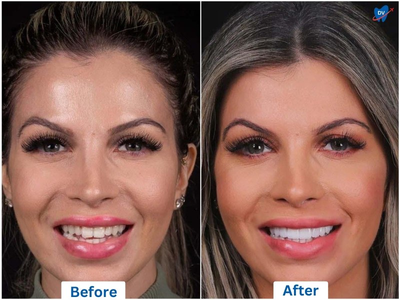 Dental Veneers, Before and After, Istanbul, Turkey