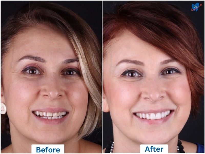 Composite Veneers, Before and After, Ankara, Turkey