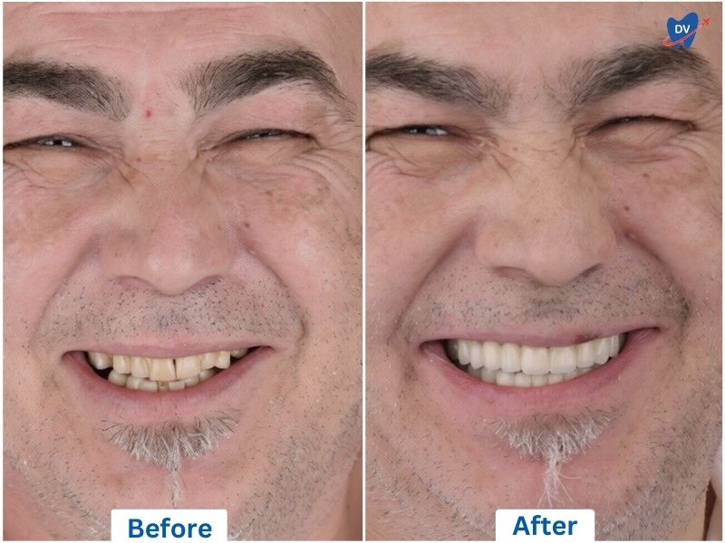 Implant supported Porcelains, Istanbul, Turkey