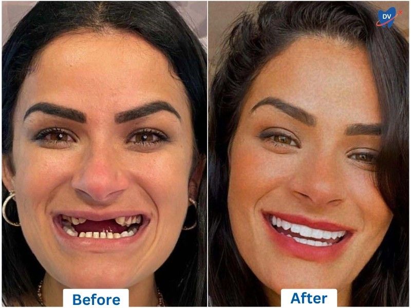 Smile Restoration with Full-Mouth Dental Implants, Istanbul, Turkey