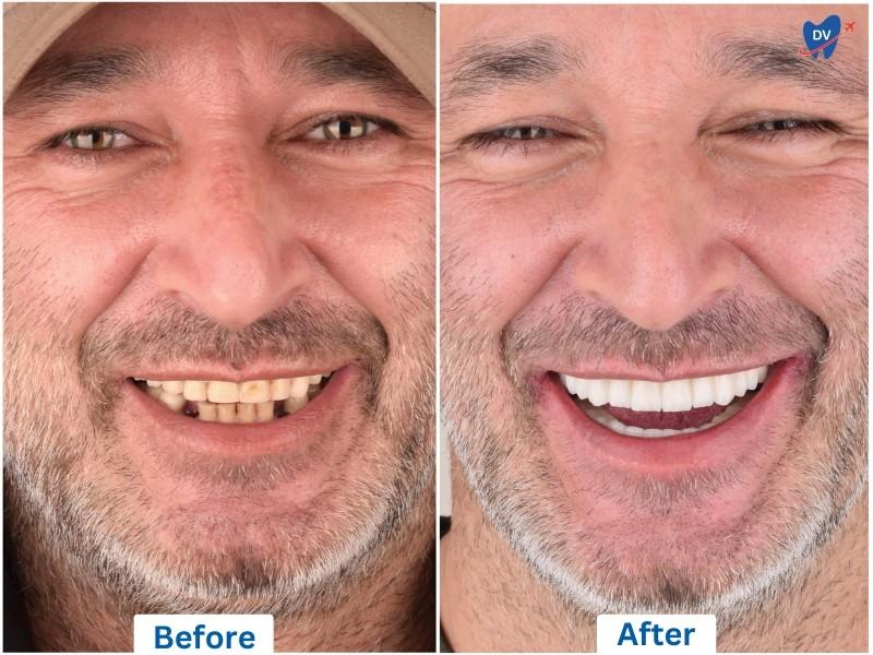 Implant supported Full-Mouth Restoration, Istanbul, Turkey