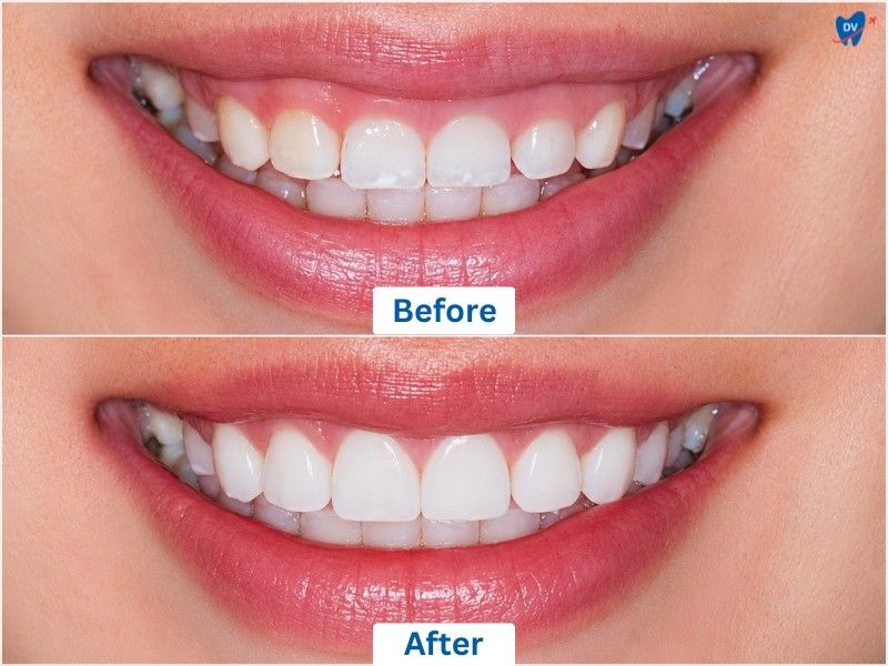 Before & After images of a woman who have undergone all-on-4 dental implant procedure in Vietnam