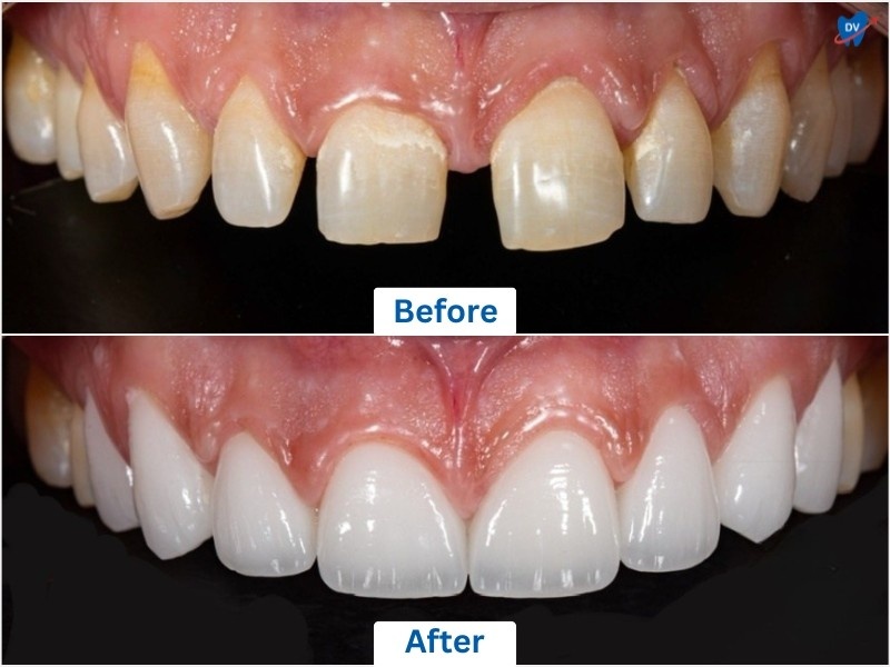 Before & After images of a person who has undergone All-on-4 dental implants procedure in Vietnam