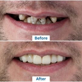 Before and after pictures of a man who has undergone all-on-6 dental implants procedure in Punta Cana