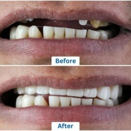Before and after pictures of a man who has undergone all-on-4 dental implants procedure in Punta Cana