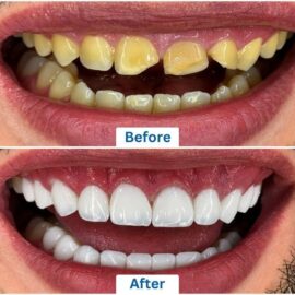 Before and after images of a man who has undergone dental implants and teeth whitening procedure in Punta Cana