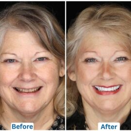 this is the before and after picture of a female dental patient who has gotten a Hollywood Smile done in Istanbul, Turkey