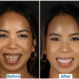 this is the before and after picture of a female dental patient who has gotten a Hollywood Smile done in Istanbul, Turkey
