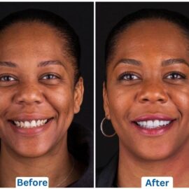 this is the before and after picture of a female dental patient who has gotten a Hollywood Smile done in Istanbul, Turkey