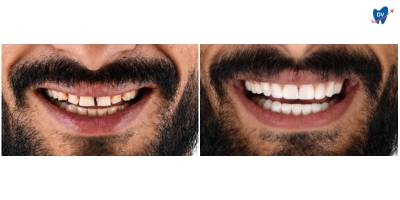 Before and after images of a man who has undergone dental implants in Cabo San Lucas