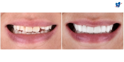 Before and after images of a man who has undergone porcelain veneers and teeth whitening