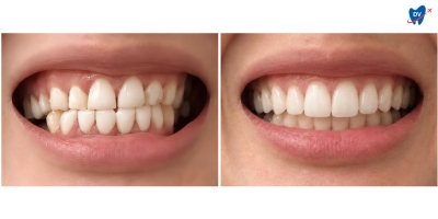 Before and after images of a man who has undergone porcelain veneers in Hanoi