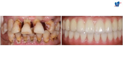Before and after images of a man who underwent full mouth restoration in Da Nang