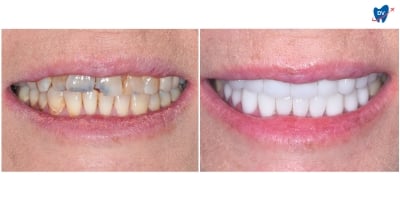 Before and after images of a woman who underwent porcelain veneers in Ho Chi Minh City