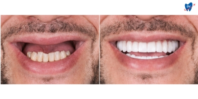 Before and after images of a man who underwent Implant-supported fixed full-arch bridge in Hanoi