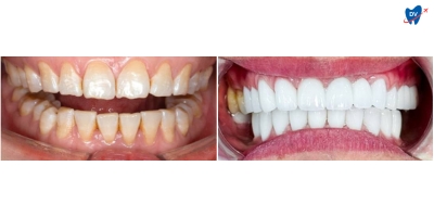 Before and after images of a woman who underwent dental veneers in Da Nang