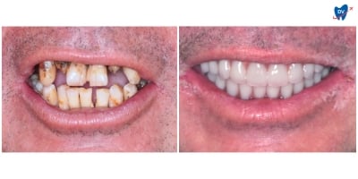 Before and after images of a man who underwent all-on-8 dental implants in Ho Chi Minh City