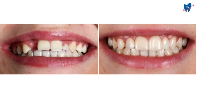 Before and after images of a woman who underwent dental implant and porcelain veneers